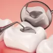 Amalgam Dolgu Nasıl Yapılır?