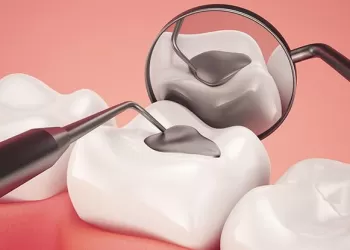 Amalgam Dolgu Nasıl Yapılır?