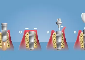 How Is Simple Dental Implant Applied?