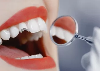 Bonding Nasıl Yapılır?