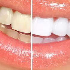 Diş Beyazlatma Nasıl Yapılır?