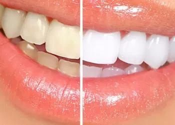 Diş Beyazlatma Nasıl Yapılır?