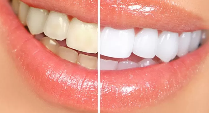 Diş Beyazlatma Nasıl Yapılır?