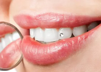 Diş Kristali Nasıl Takılır?