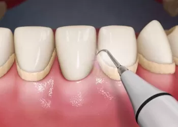 Diş Taşı Temizliği Nasıl Yapılır?