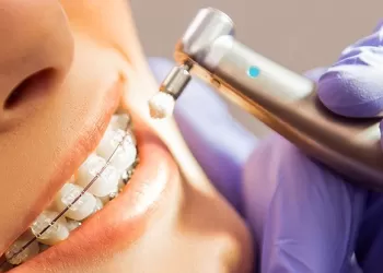 Diş Teli Tedavisi Aşamaları