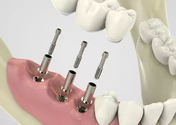 Bir Seansta En Fazla Kaç İmplant Yapılır?