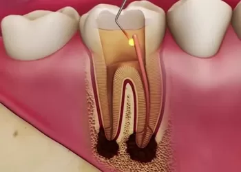 Fiber Post Nasıl Yapılır?