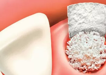 Greft Nedir? Ne İşe Yarar?