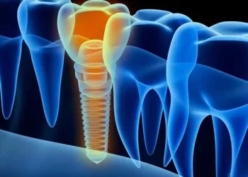 İmplant Tedavisinde Planlama