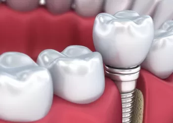 İmplant Zararlı Mı?