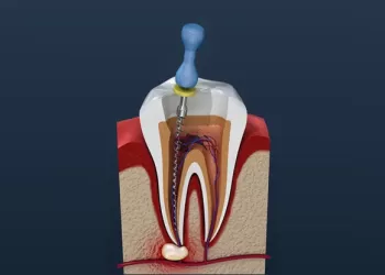Kanal Tedavisi Nedir?