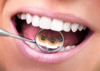 Lingual Diş Teli Tedavisi