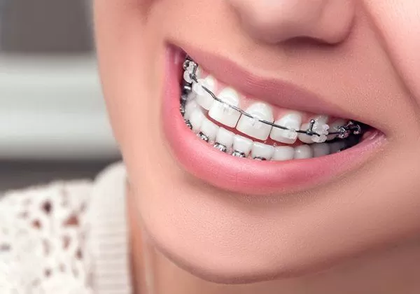 ortodonti tedavi fiyatları