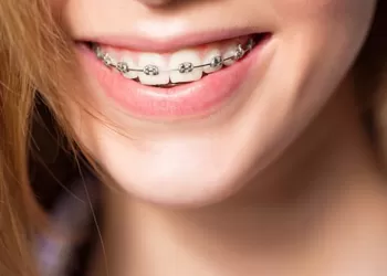 Ortodonti Süreci Nasıl Kısalır?