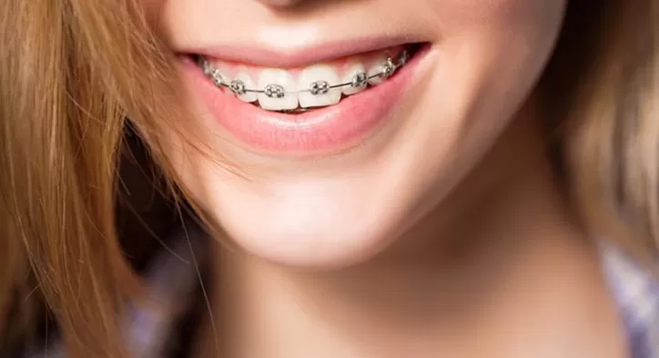 Ortodonti Süreci Nasıl Kısalır?