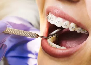 Ortodontik Tedavide Diş Çekilir Mi?