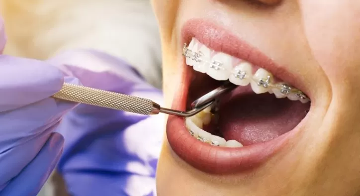 Ortodontik Tedavide Diş Çekilir Mi?