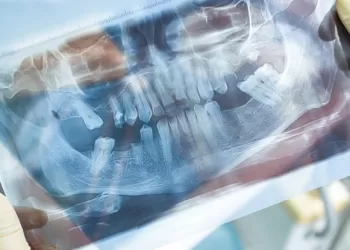 Periimplantitis Nedir?