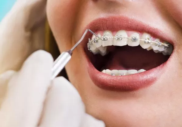 sabit ortodontik tedavi