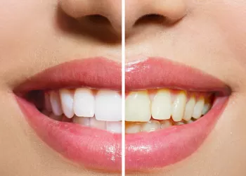 Dişler Neden Sararır?