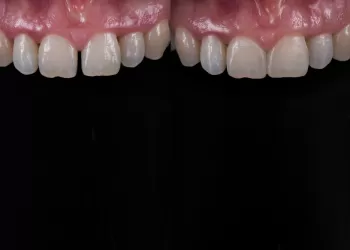 Bonding Nedir? Nasıl Yapılır?