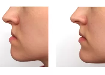 Çene Bozukluğu Tedavi Edilmezse Ne Olur?