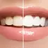 Sararmış Dişler İçin Diş Beyazlatma Yöntemleri