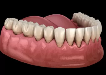 Diş Eti Çekilmesi Neden Olur?