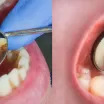 Diş Taşı Nedir? Diş Taşı Nasıl Oluşur?