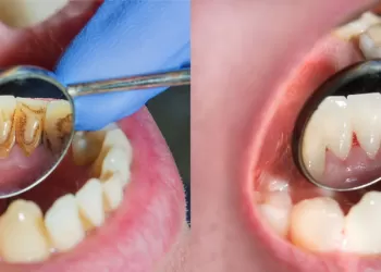 Diş Taşı Nedir? Diş Taşı Nasıl Oluşur?