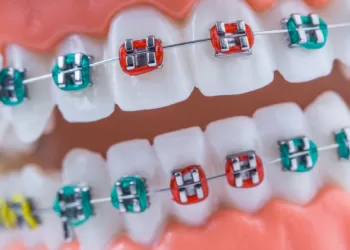 Hangi Diş Teli Renkleri Var? Hangisi Senin İçin En İyisi?