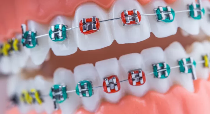 Hangi Diş Teli Renkleri Var? Hangisi Senin İçin En İyisi?