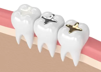 Dolgu Nedir? Dolgu Çeşitleri Nelerdir?