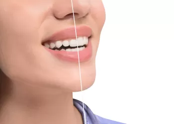 Gingivektomi ve Gingivoplasti Nedir?