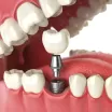 İmplant Üstü Diş Protezi Tedavisi Nasıl Yapılır?