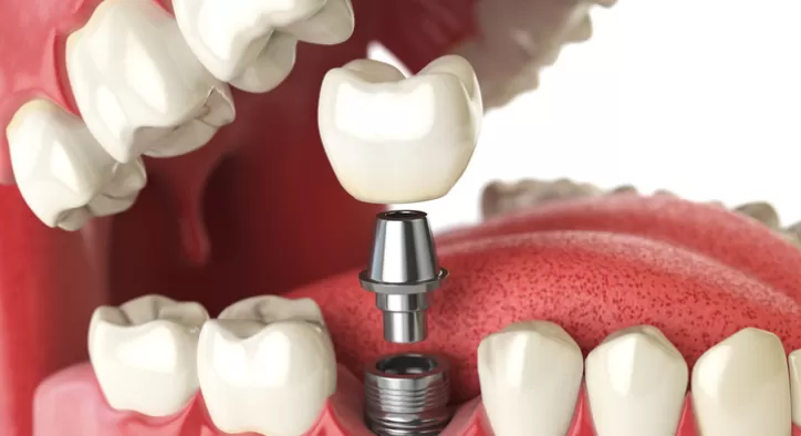 İmplant Üstü Diş Protezi Tedavisi Nasıl Yapılır?