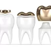 İnley Onley Diş Restorasyonları Nasıl Yapılır?