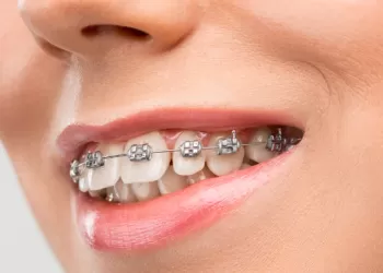 Metal Diş Teli Fiyatları Neye Göre Belirlenir?