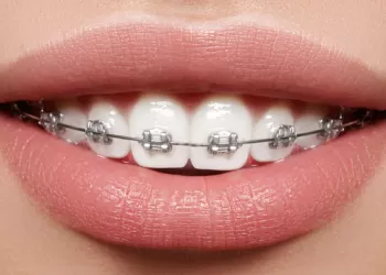 Metal ve Seramik Braketler Arasındaki Farklar Nelerdir?