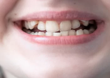 Ortodonti Nedir? Diş Çapraşıklığı Nasıl Tedavi Edilir?