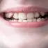 Ortodonti Nedir? Diş Çapraşıklığı Nasıl Tedavi Edilir?