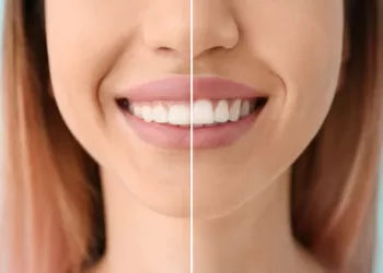 Pembe Estetik Nedir? Kimler Yaptırabilir?