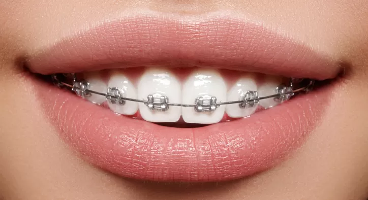 Şeffaf Plak ile Şeffaf Diş Teli Arasındaki Farklar Neler?