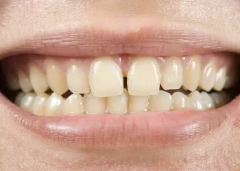 Ayrık Diş Tedavisi