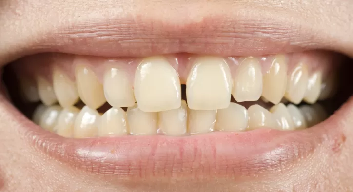 Ayrık Diş Tedavisi